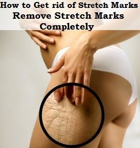 Get Rid Of Stretch Marks Naturally In Just Weeks Get Rid Of Stretch Marks Naturally In Just Weeks