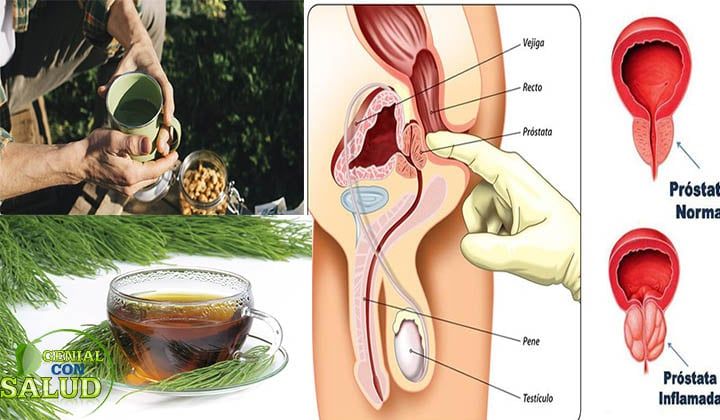 ¿Qué es una glándula prostática inflamada?
