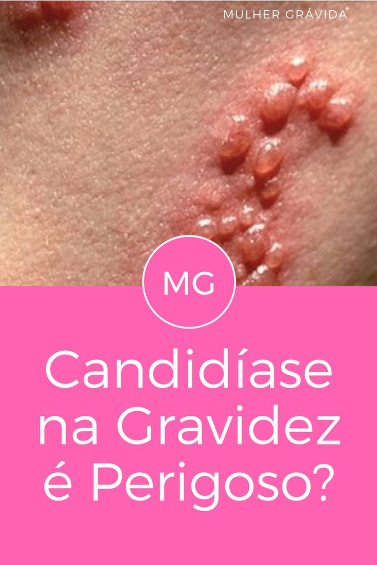 como tratar candida albicans na unha