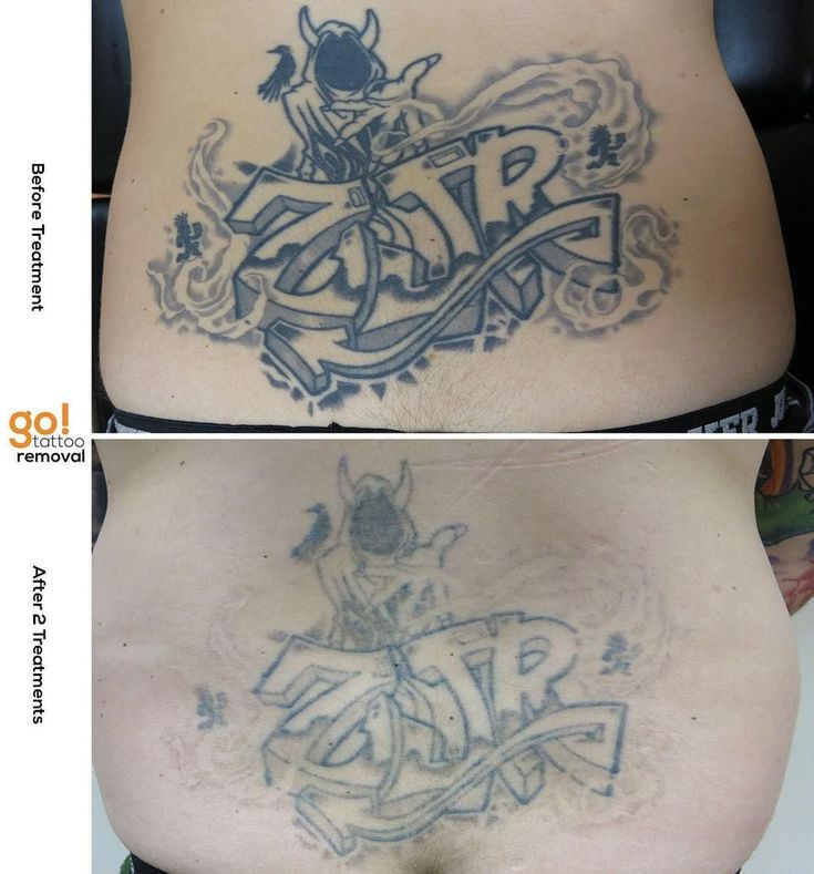 Typically Speaking Tattoos On The Torso Fade Really Well Although The Lower Back Has Been Known To Give Up A Good F Tattoo Removal Tattoos Laser Tattoo Removal Typically Speaking Tattoos On The Torso Fade Really Well Although The Lower Back Has Been Known To Give Up A Good F Tattoo Removal Tattoos Laser Tattoo Removal