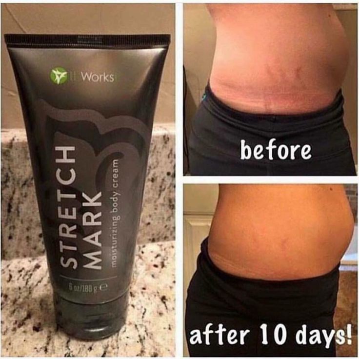 29 best stretch mark cream images on pinterest stretch mark cream it works stretch marks cream