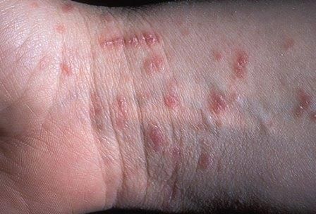 varicose piele
