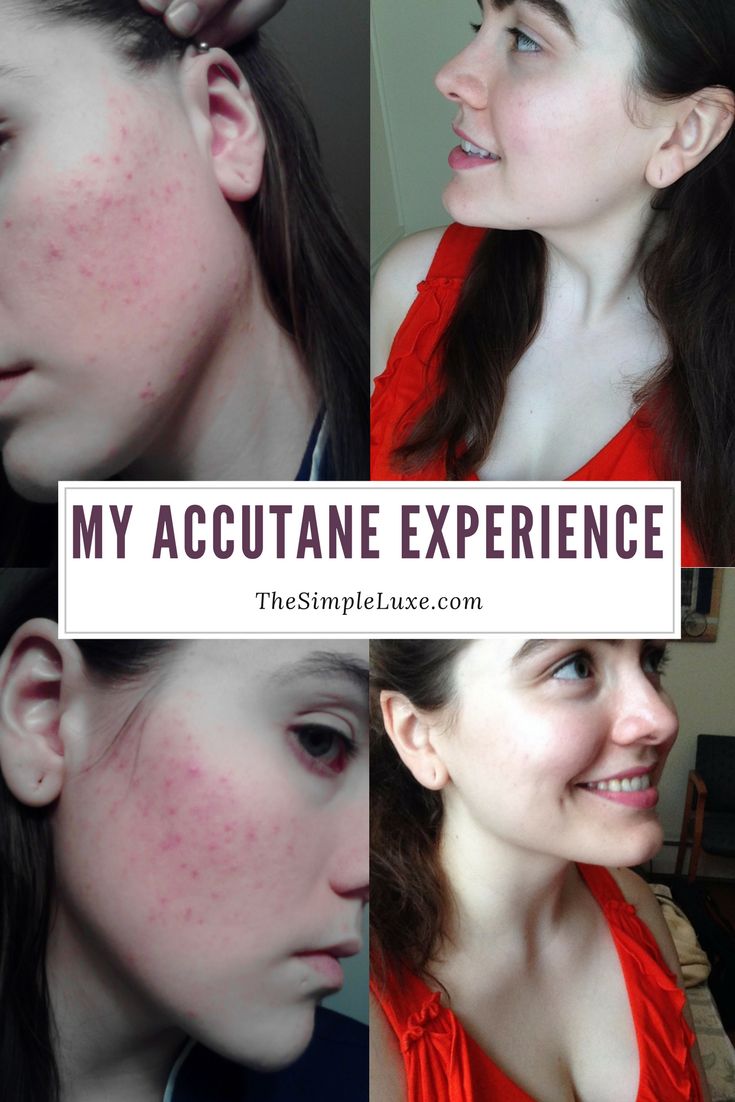 isotretinoin accutane isotretinoin accutane