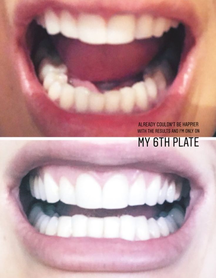 invisible aligners vs braces invisible aligners vs braces