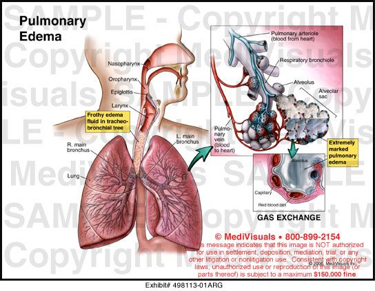 Edema ankle cpap machines