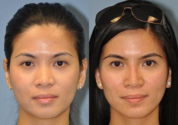 Asian nose bridge surgery