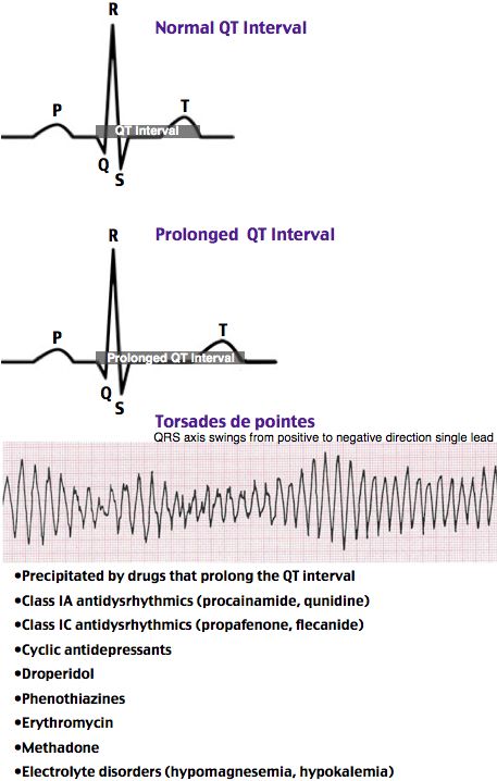 Ventricular Tachycardia Natural Remedies Ventricular Tachycardia Natural Remedies