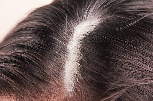 white scalp build up