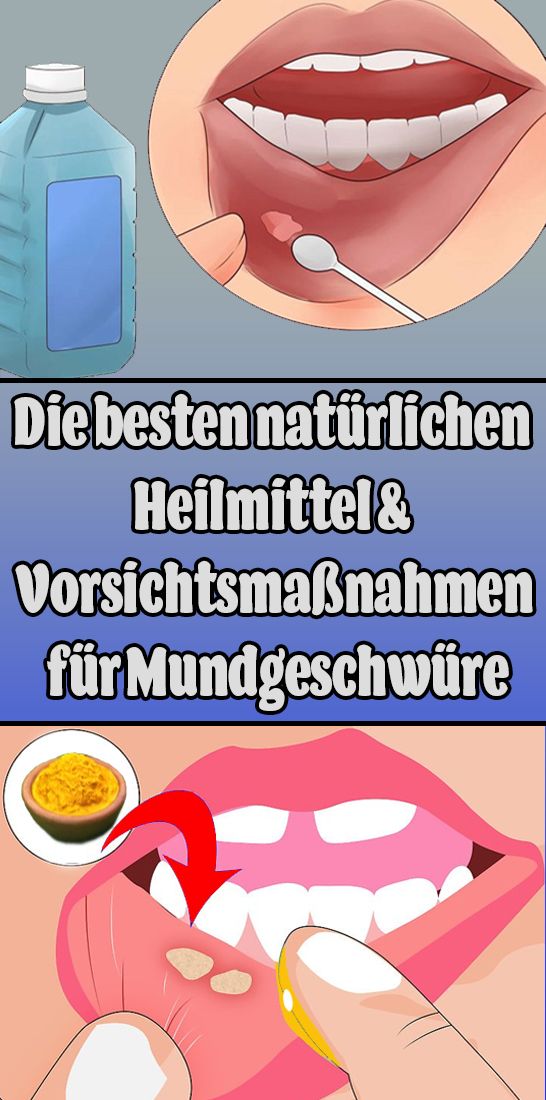 Die besten natürlichen Heilmittel und Vorsichtsmaßnahmen für Mundgeschwüre