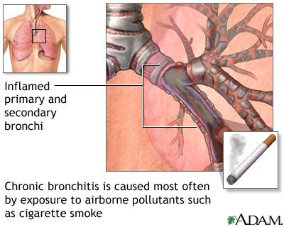 Is bronchitis catchy