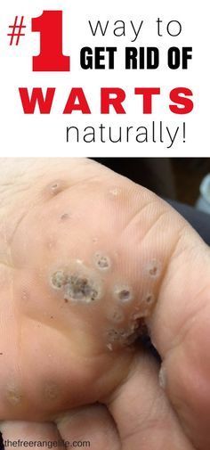 Best Way To Get Rid Of Ear Infection Naturally Best Way To Get Rid Of Ear Infection Naturally