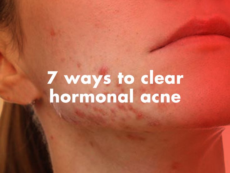 hormone changes adult acne hormone changes adult acne