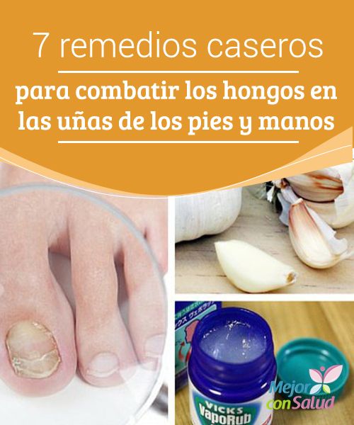 Las fases del hongo de las uñas en las manos