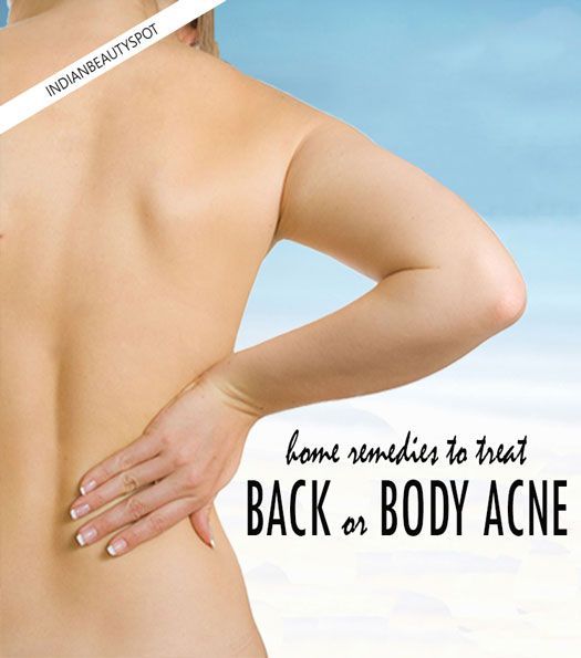 Natural Way To Get Rid Of Bacne Natural Way To Get Rid Of Bacne