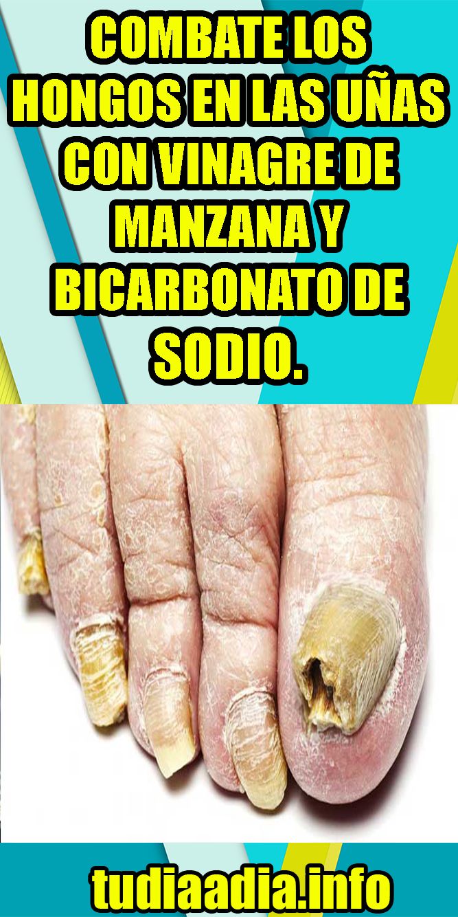 Bicarbonato unas pies quitar hongos