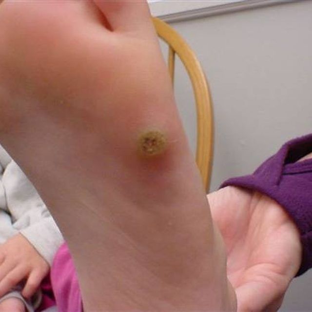 wart stages
