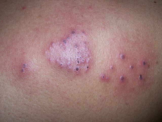 having oral sex herpes having oral sex herpes