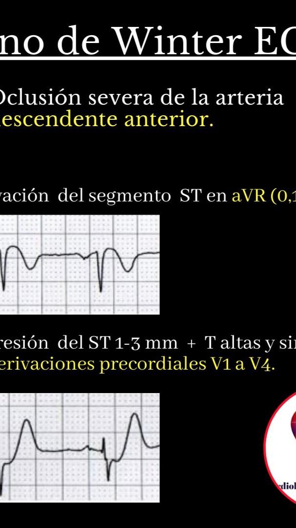 Signo de Winter ECG Crossword puzzle Crossword Puzzle Signo de Winter ECG Crossword puzzle Crossword Puzzle