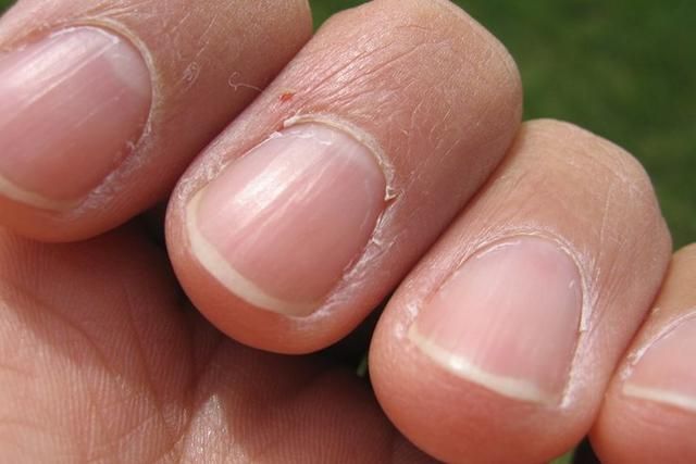 Whoops Healthy Nails Nail Signs Nail Problems whoops-healthy-nails-nail-signs-nail-problems