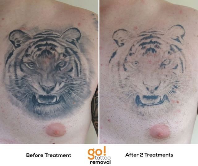 Not Happy With The Cover Up The Client Has Come In To Start Fading This Entire Chest Piece To Be Re Tattoo Removal Tattoos For Kids