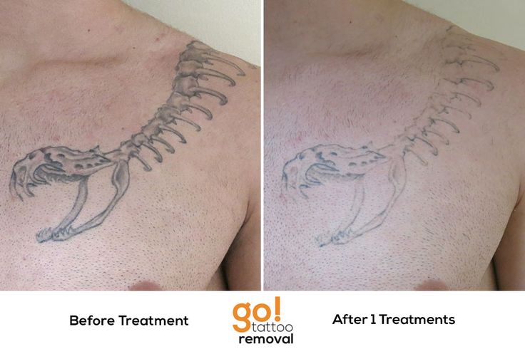 the valley u0027s best tattoo removal with the exclusive picoway laser the valley u0027s best tattoo removal with the exclusive picoway laser
