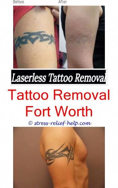 How To Start A Tattoo Removal Business Uk Green Can I How To Start A Tattoo Removal Business Uk Green Can I Get Laser While Pregnant