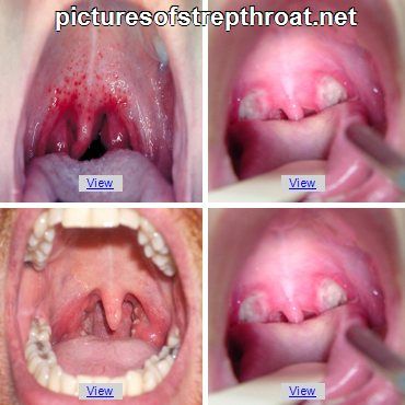 Torrie Willson Porn Contagious Period For Strep Throat