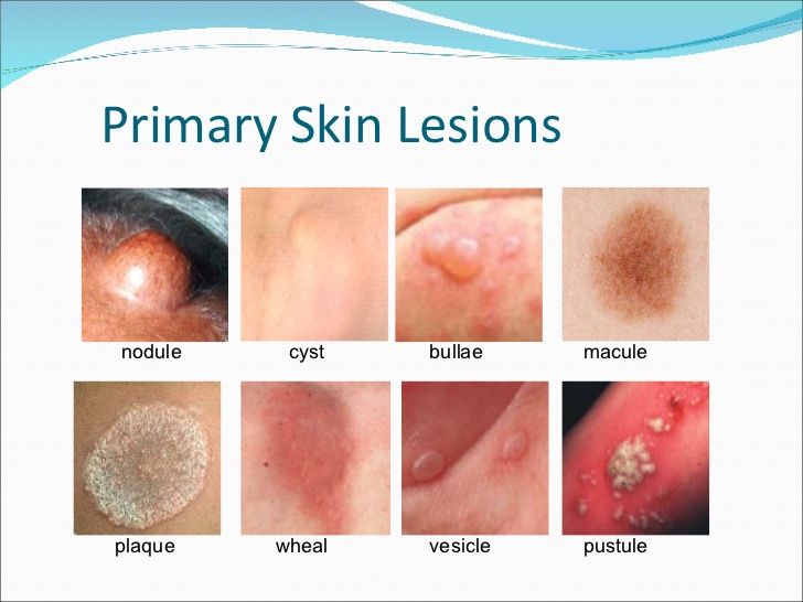 skin lesions pediatric nursing skin disorders skin lesion chart