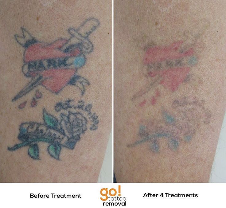 827 best tattoo removal in progress images on pinterest 827 best tattoo removal in progress images on pinterest