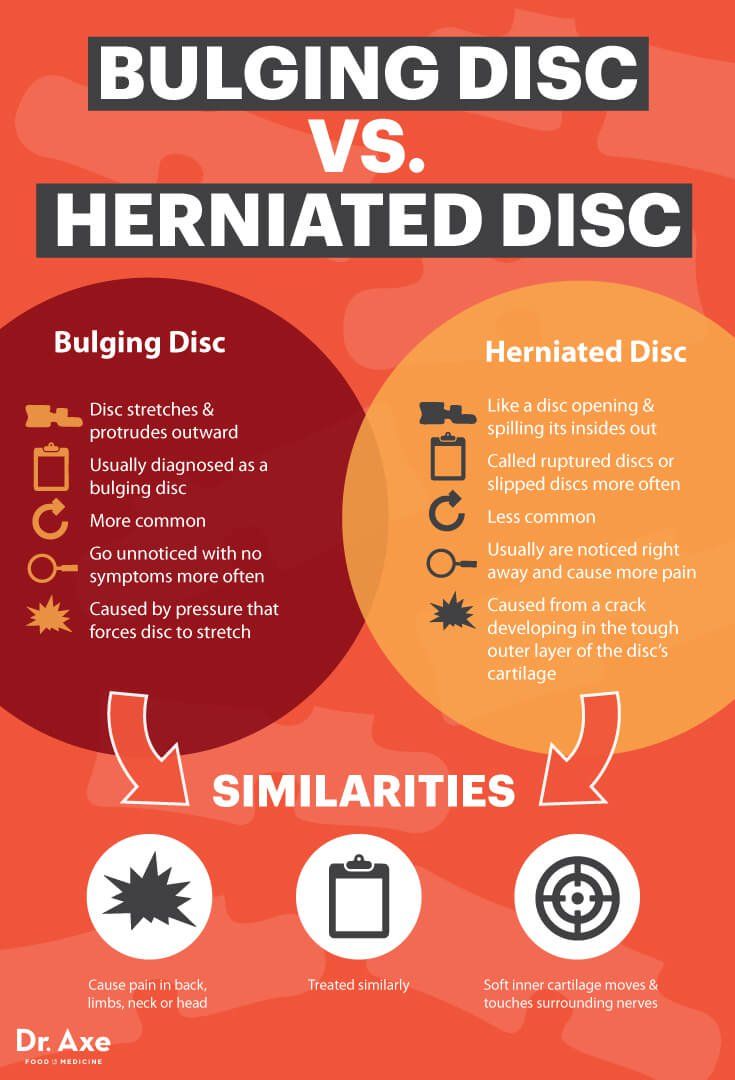 Natural Remedies For Herniated Disc In Lower Back Natural Remedies For Herniated Disc In Lower Back