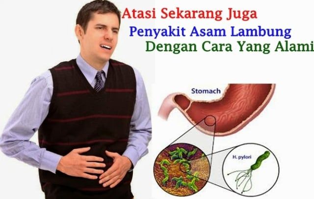 Cara Mengobati Sakit Lambung Akut