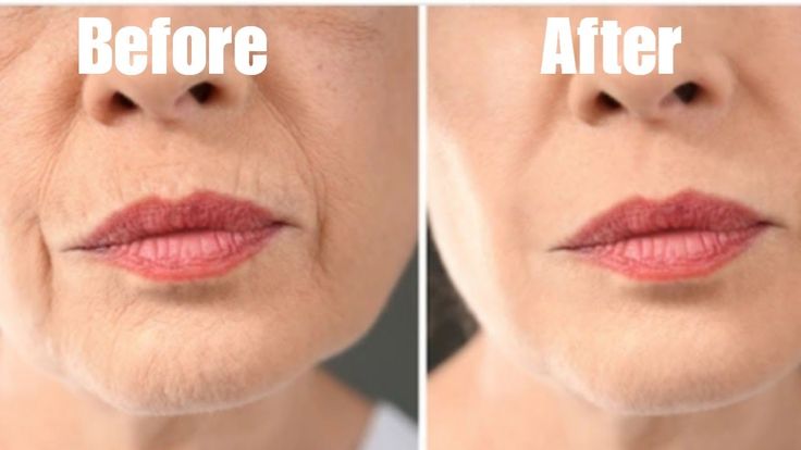 indian home remedies for wrinkles on face
