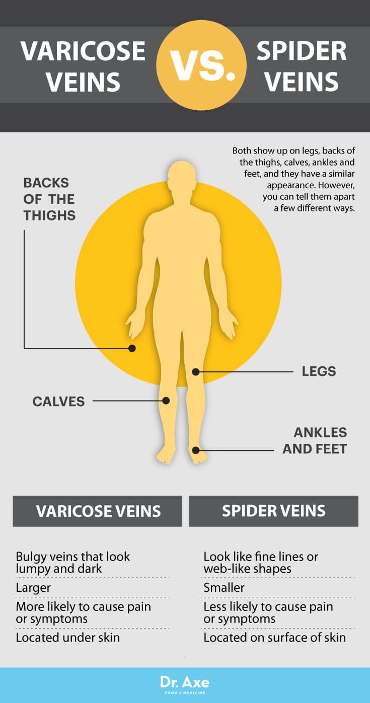 varicose truck
