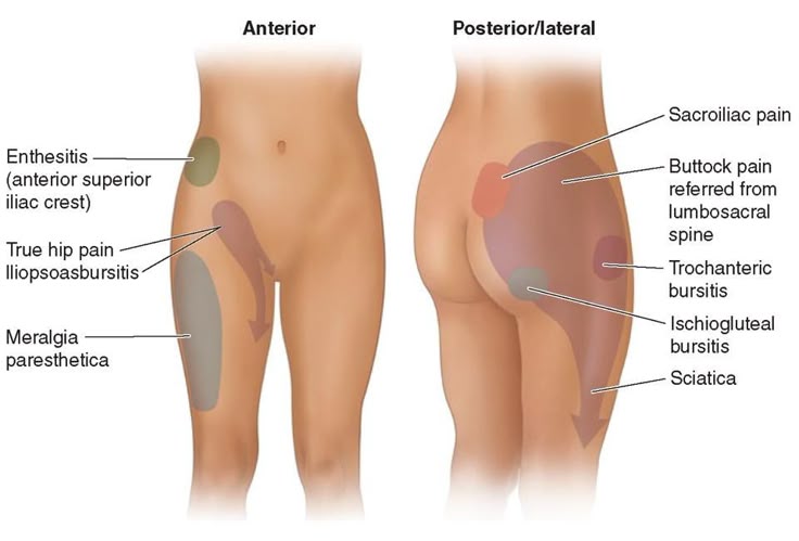 Natural Remedies For Arthritis Hip Pain Natural Remedies For Arthritis Hip Pain