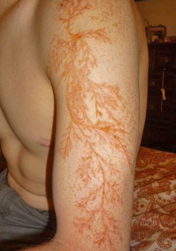 lightning scars images lightning scars images