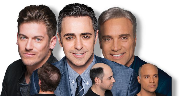 Treating Female Pattern Baldness Naturally Treating Female Pattern Baldness Naturally