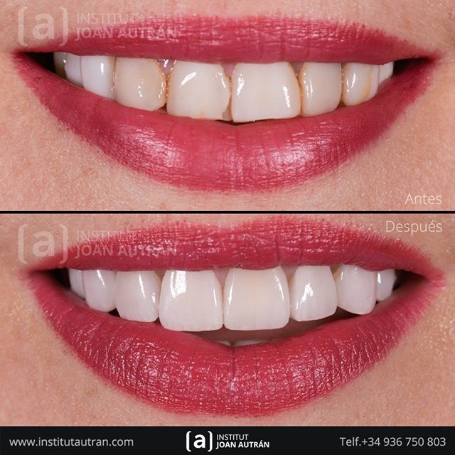 Finalizamos La Semana Devolviendo Una Nueva Sonrisa Con El Tratamiento De Carillas Sin Tallado Top Smile Solicite Una Visita En Nuest Dental Teeth Cosmetics