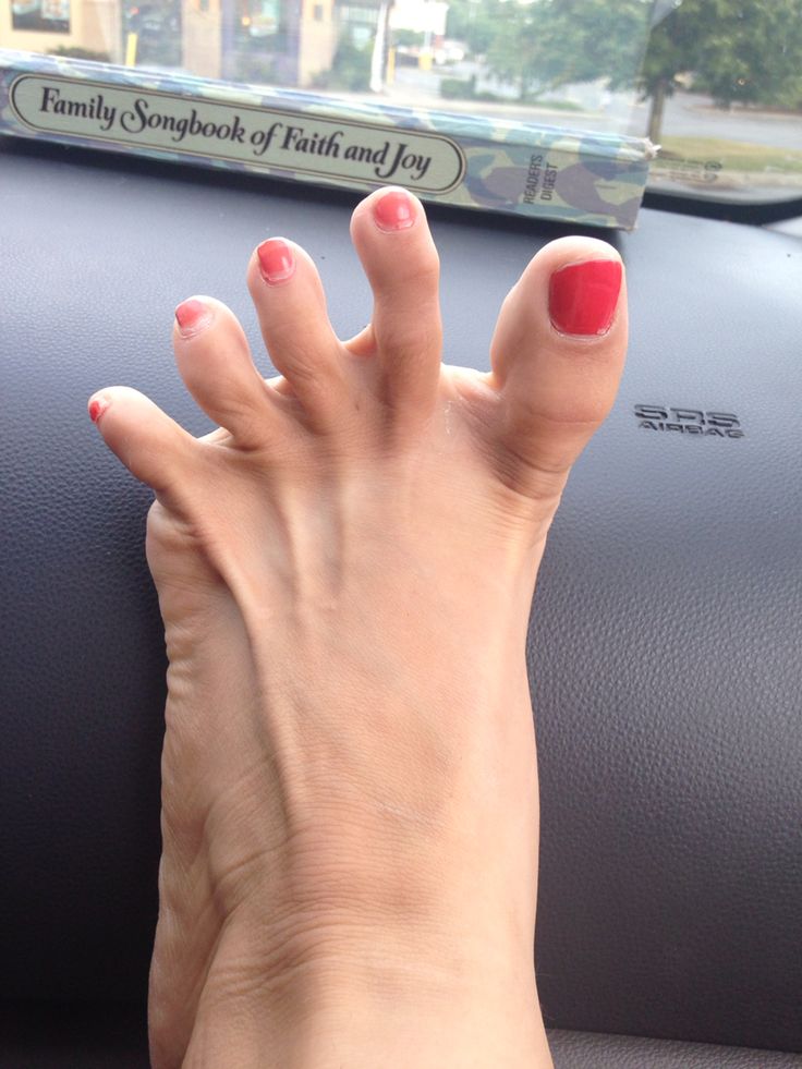 Crazy Toes Middle Toe Ehlers Danlos Syndrome Awareness Toe Exercises crazy-toes-middle-toe-ehlers-danlos-syndrome-awareness-toe-exercises