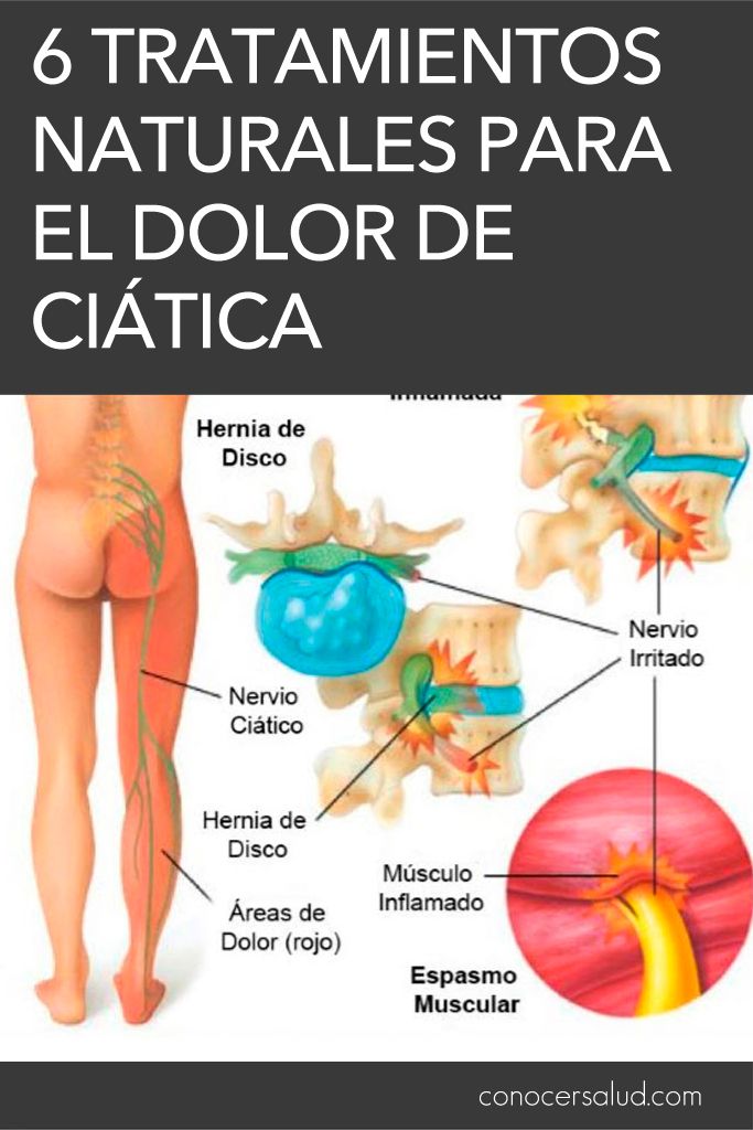 6 Tratamientos Naturales Para El Dolor De Ciática Salud Regular Exercise Muscle Fitness Health