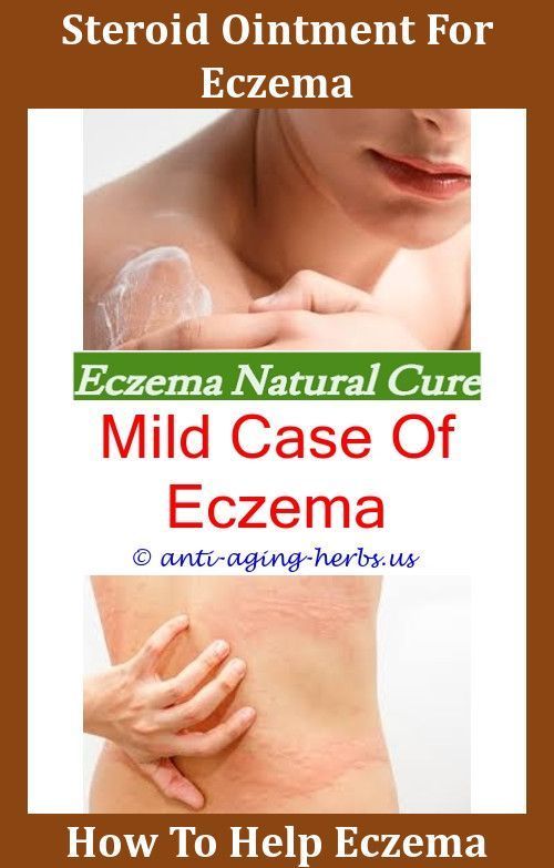 Baby #Eczema #Cream #Eczema #Psychological #Causes,it #works #eczema.Best #Cure #For #Eczema #Eczema #Symptoms,skin #microbiome #eczema #- #allergic #eczema #face #eczema #returns #after #prednisone #laser #hair #removal #eczema #eczema #insomnia #manuka #honey #eczema.