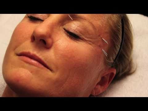 Acupuncture,Acupuncture Near Me,Acupuncture Benefits,Acupuncture For Fertility,Acupuncture For Weight Loss