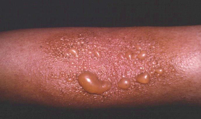 Natural Ways To Cure Inflammation Natural Ways To Cure Inflammation