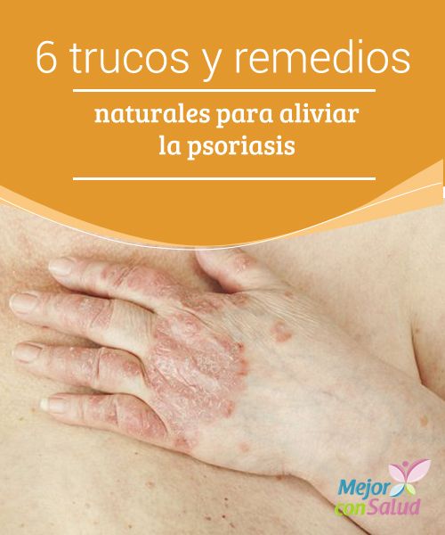 El tratamiento de la psoriasis por los ungüentos en base a la grasa de lubricación