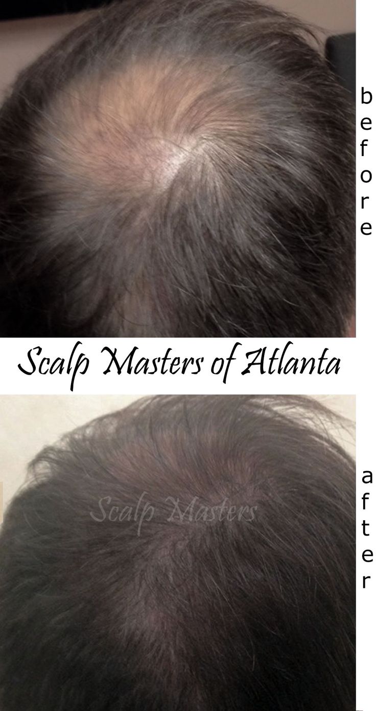 atlanta crown balding solutions | Male pattern baldness, Pattern baldness, Baldness solutions How To Get Burrs Out Of Human Hair