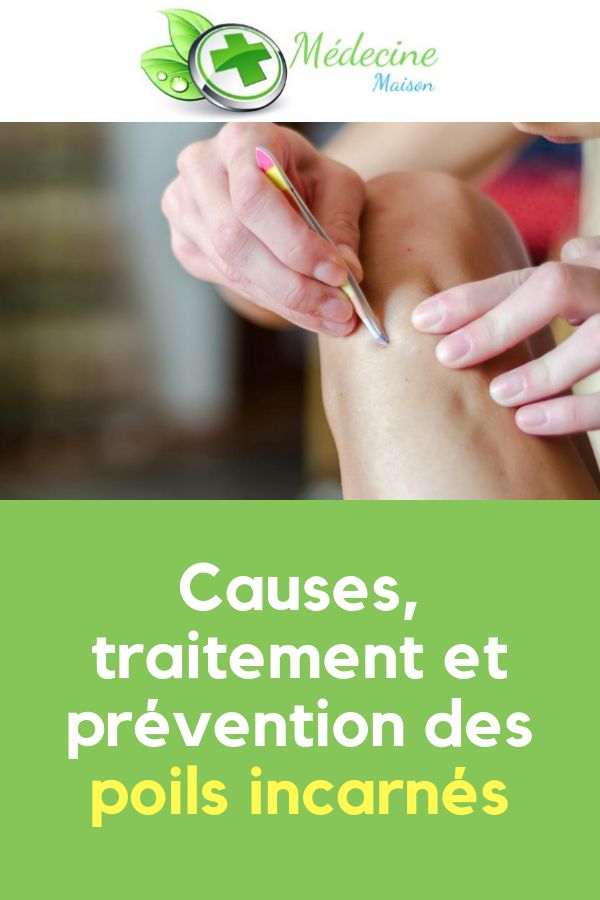 Causes, traitement et prévention des poils incarnés | Poil ... Causes, traitement et prévention des poils incarnés | Poil ...