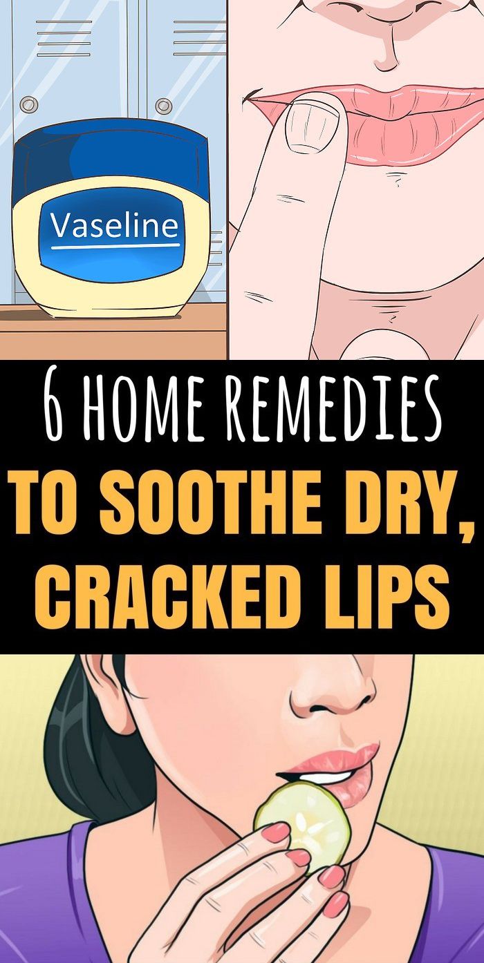 Here Are 6 Home Remedies To Soothe Dry Cracked Lips Cracked