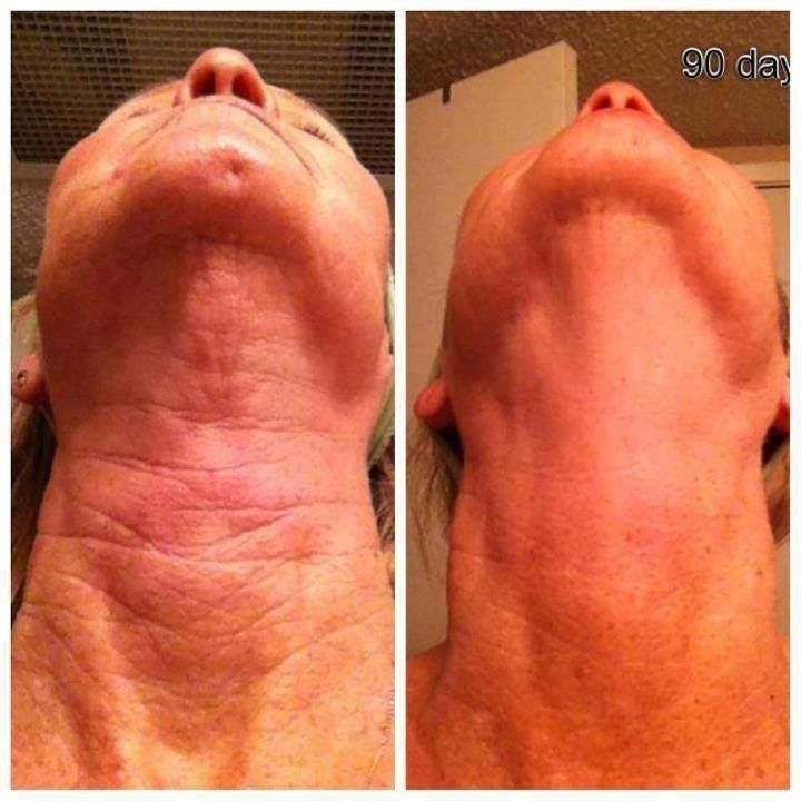 Best Natural Treatment For Deep Wrinkles Best Natural Treatment For Deep Wrinkles