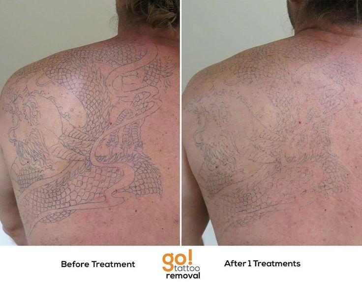 827 best tattoo removal in progress images on pinterest 827 best tattoo removal in progress images on pinterest