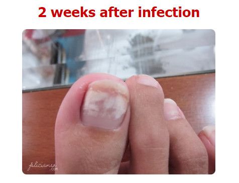 Fungus infections and vitamins
