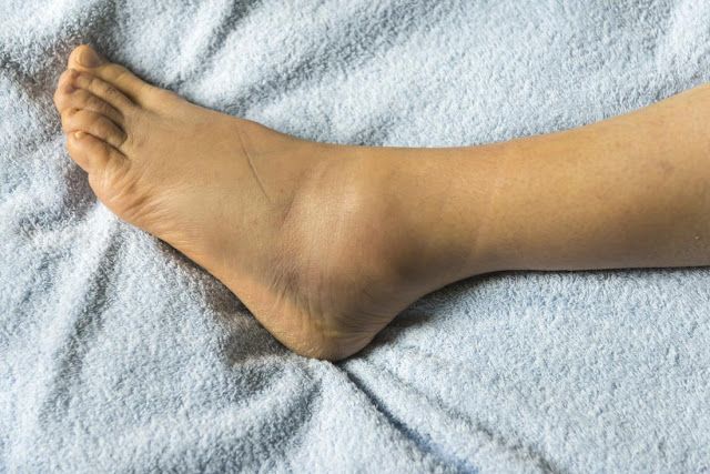 varicoza nu progreseaza exerciiu de slabire cu varicoza